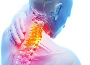 Üçüncü derece osteokondroz ile servikal bölgede ağrı ve barınaklar