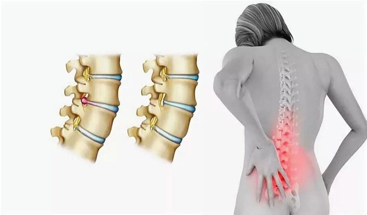 Spinal osteokondroz tehlikesi